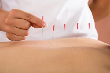 Person Receiving Dry Needling Treatment
